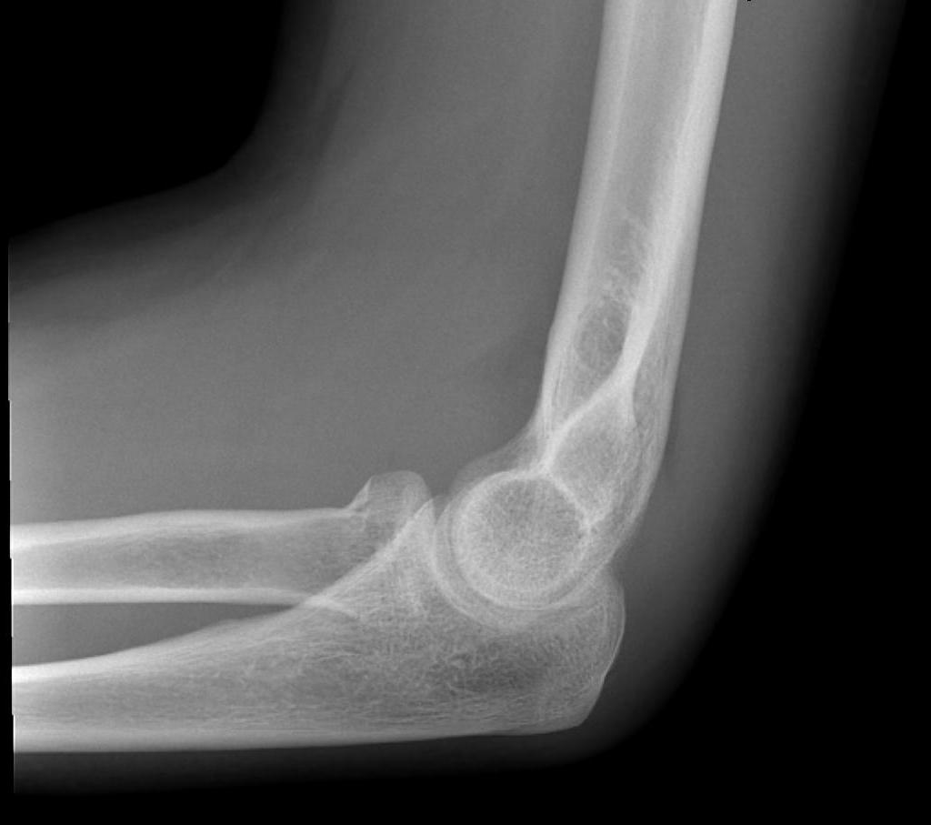 Elbow Lateral Normal